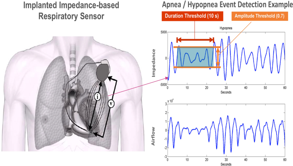 sleep study report